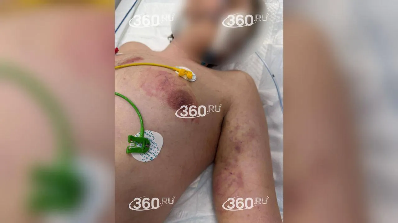 Тяжело пострадавший пациент рехаба в Дедовске. Сейчас мальчик в коме