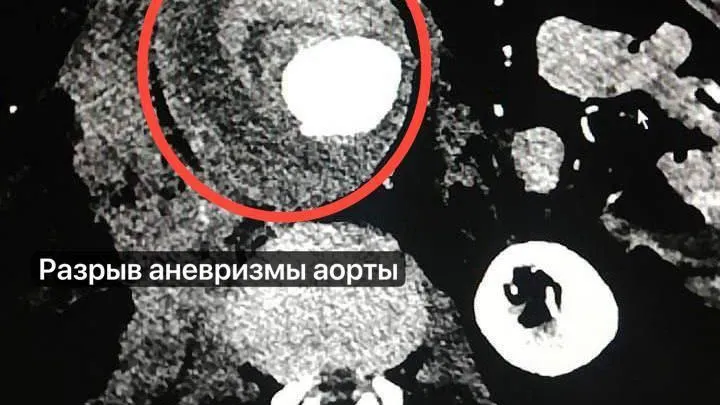 иллюстрационное фото разрыва аорты